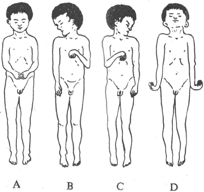 人类去皮层僵直及去大脑僵直