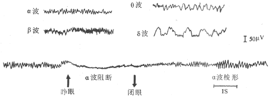 正常脑电波各种波形