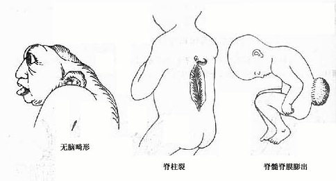 神经系统的几种畸形 