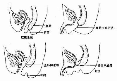 不通肛 