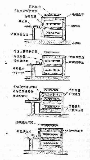  微循环障碍的发展过程模式图