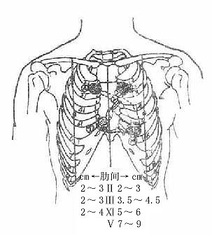 心的体表投影及心界叩诊