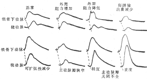 不同情况下锁骨下动脉与桡动脉的脉搏图